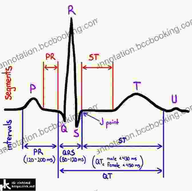 ECG Wave Morphology Diagram ECG / EKG Interpretation: A Systematic Approach To Read A 12 Lead ECG And Interpreting Heart Rhythms In 15 Seconds Or Less Without Memorization