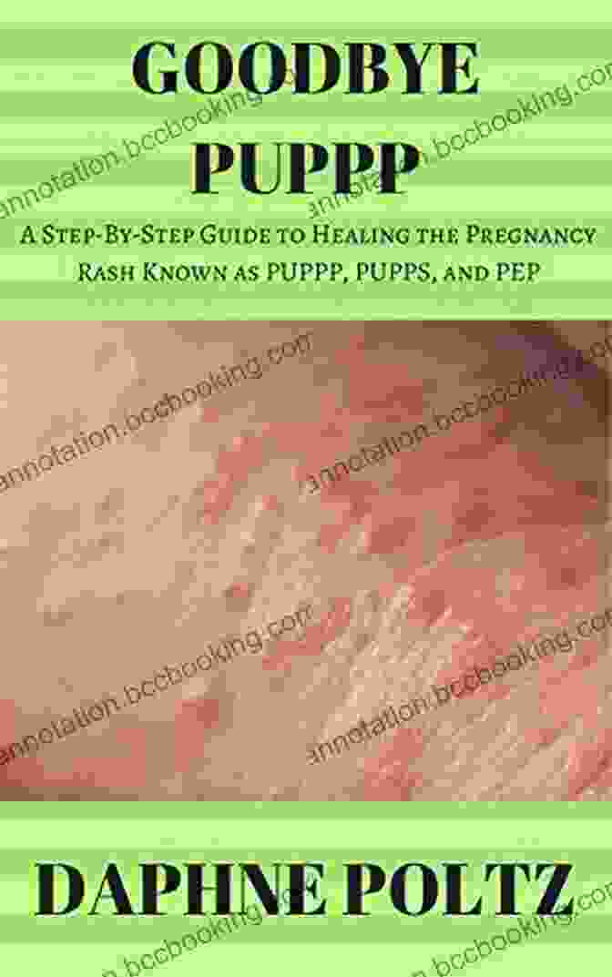 PUPPP, PUPPS, And PEP Rash Goodbye PUPPP: A Step By Step Guide To Healing The Pregnancy Rash Known As PUPPP PUPPS And PEP